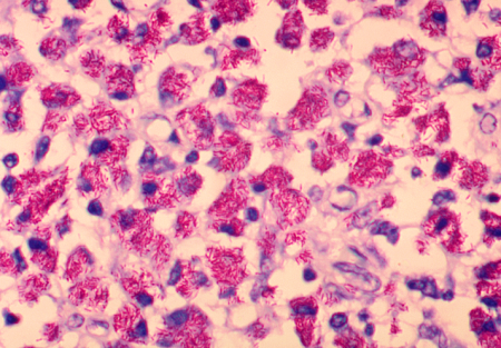 Mycobacterium avium (imagem) e Mycobacterium abscessus) são espécies de micobactérias que exigem tratamentos longos, demorados e que nem sempre funcionam (Wikipedia)